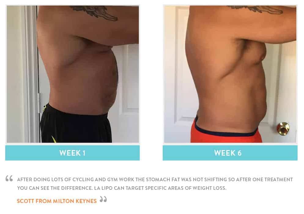 Before & After Stomach Fat Dunstable