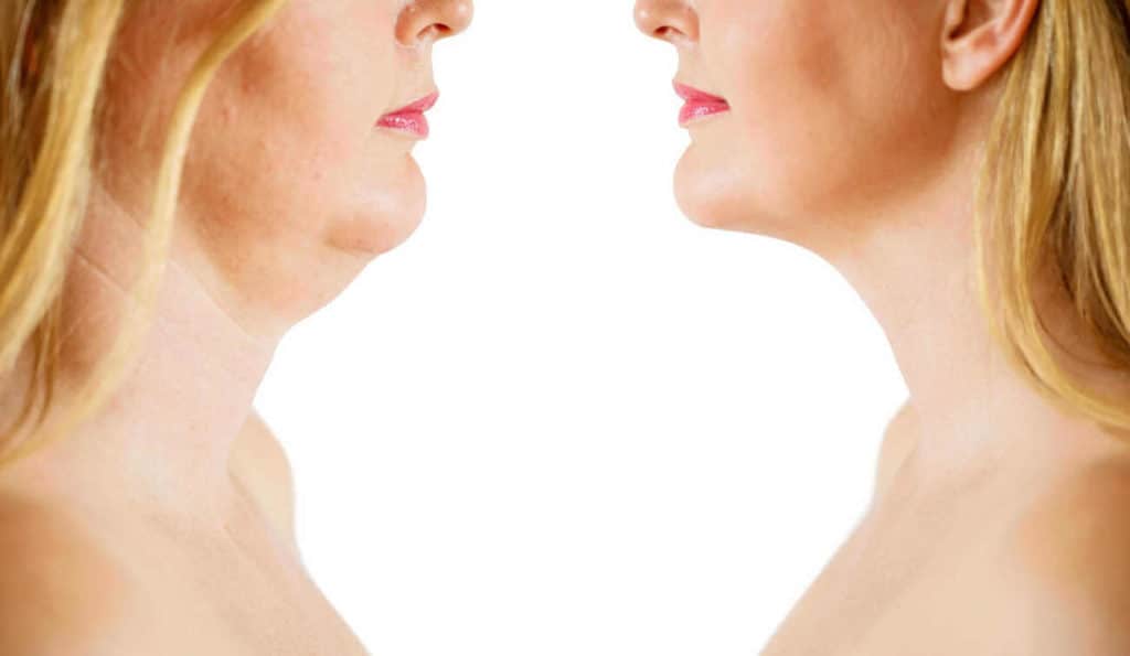 Double Chin treatment Dunstable before and after results