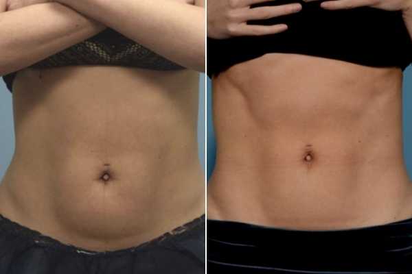 body sculpting FAQs Dunstable