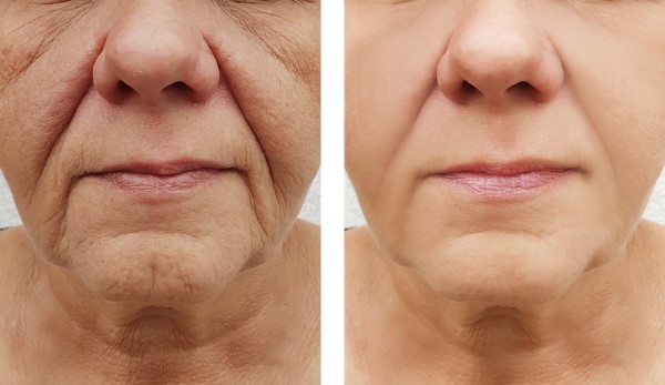 Learn more about Morpheus8 Treatment Dunstable today!