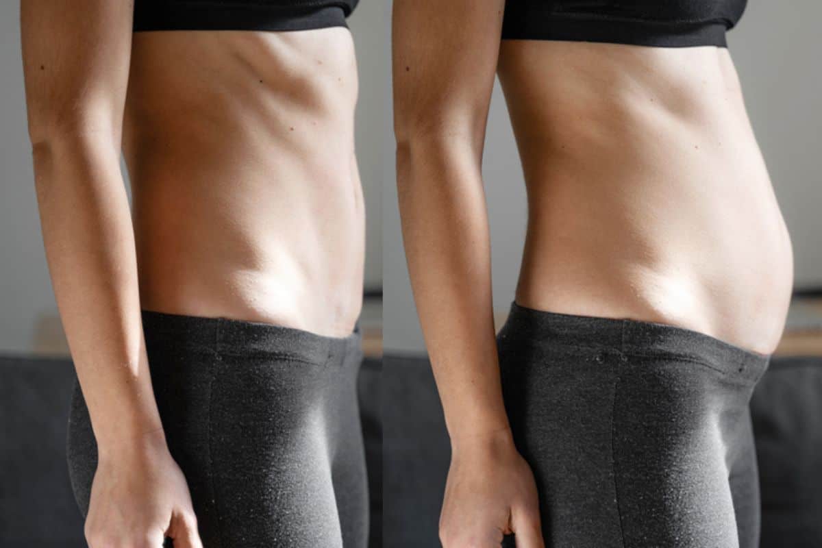 How long does diastasis recti take to improve Dunstable?