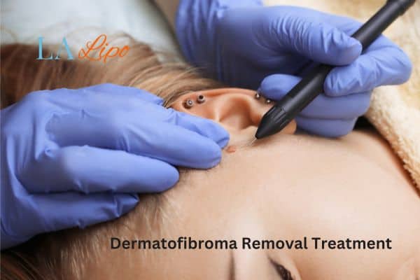 Dermatofibroma Removal Treatment Dunstable