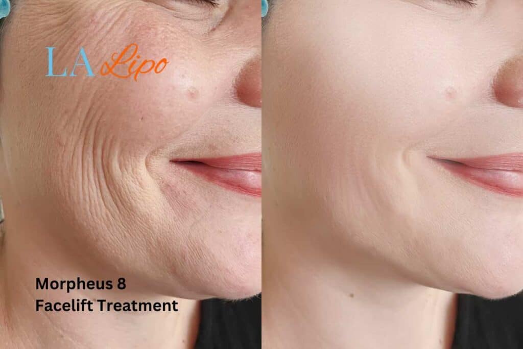 Morpheus8 Treatment Dunstable for flawless skin! Call us today!