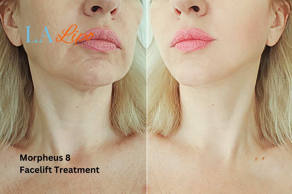 Turn back time with Morpheus8 Treatment Dunstable