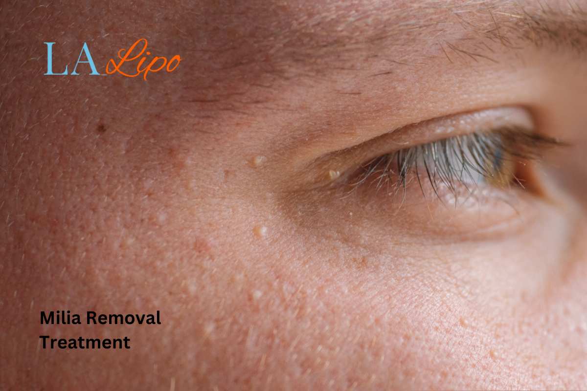 Cryopen Milia Removal: Is It the Easiest and Safest Option Dunstable?