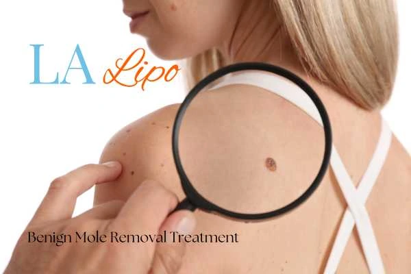 Woman having her inspection of blemish before mole removal Dunstable
