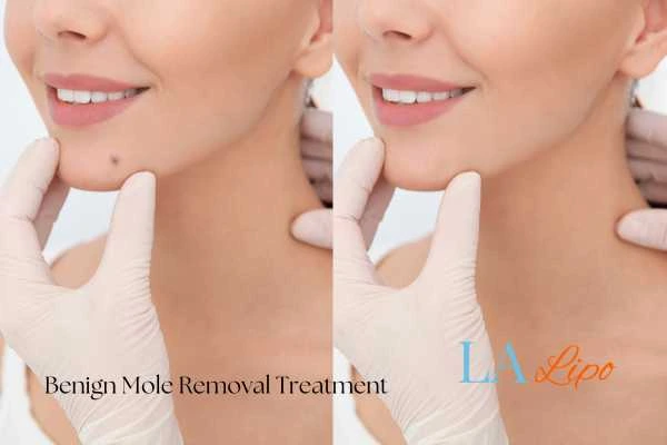 Before and after mole removal Dunstable treatment