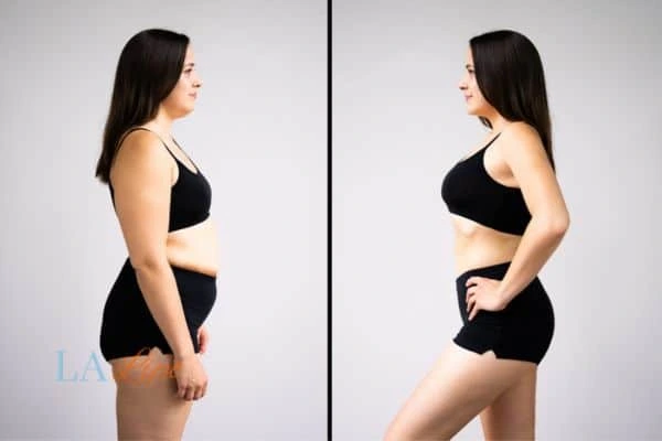 image of woman before and after results of LA-EMS Body Sculpting Dunstable to help treat Diastasis recti