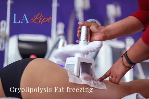 women getting fat freezing Dunstable