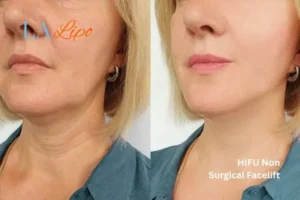 hi-fu for wrinkles Dunstable before and after results