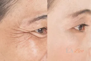 Before and after results of woman - HI-fu wrinkles reduction treatment Dunstable