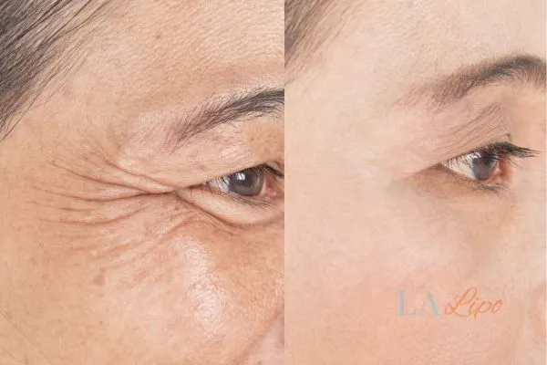 Before and after results of woman - HI-fu wrinkles reduction treatment Dunstable