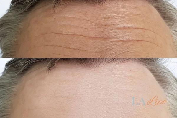results of HIFU Dunstable on mans forehead to help reduce lines and wrinkles