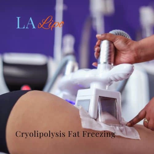 fat freezing - Cryolipolysis Dunstable