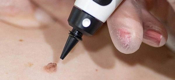 skin tag removal using cryopen Dunstable