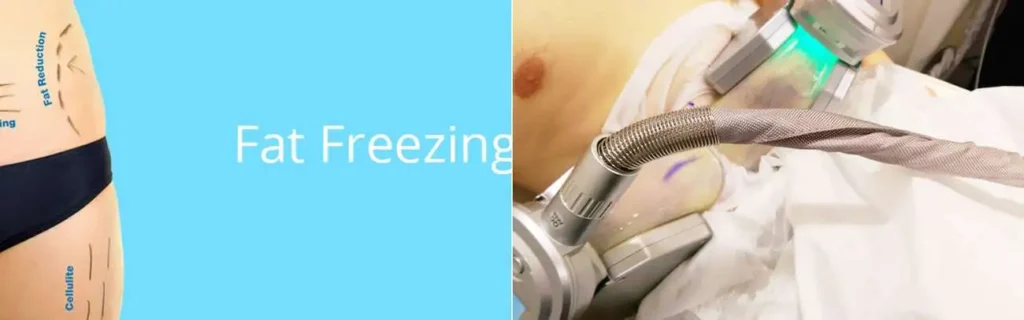 multi areas of a persons body having coolsculpting Dunstable treatment
