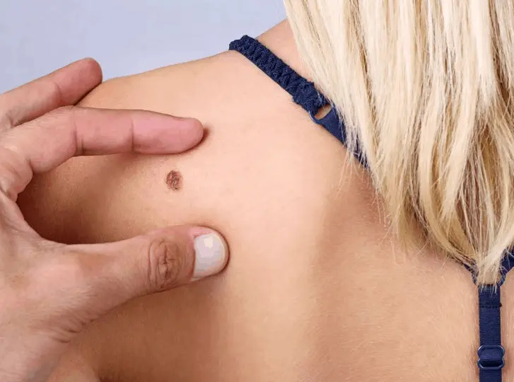 woman having mole removal Dunstable consultation before treatment.
