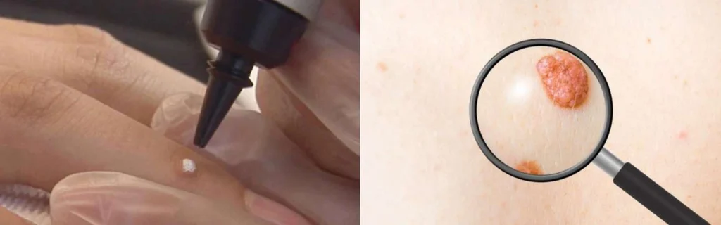 CryoPen practitioner Dunstable assessing a benign mole before treatment