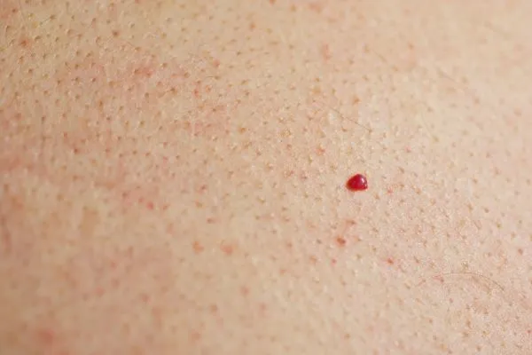 close up of a cherry angioma Dunstable