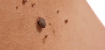image of a skin tag Dunstable