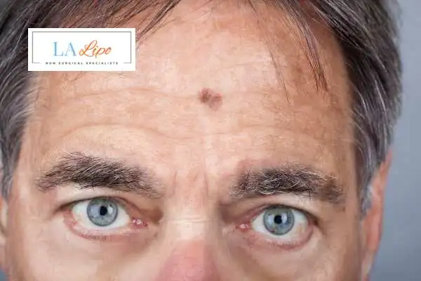 Solar Lentigo Removal Dunstable image of man with mark on his forehead
