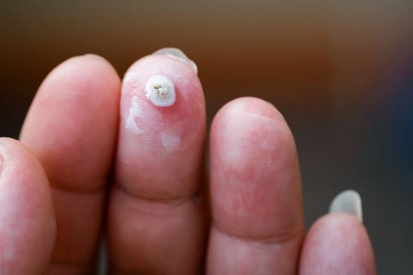 wart on person finger - cryotherapy to treat from LA LIPO Dunstable