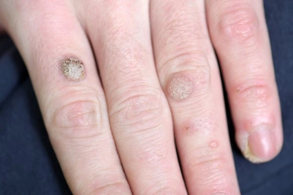 photo of warts on person hand - see wart removal Dunstable from LA LIPO