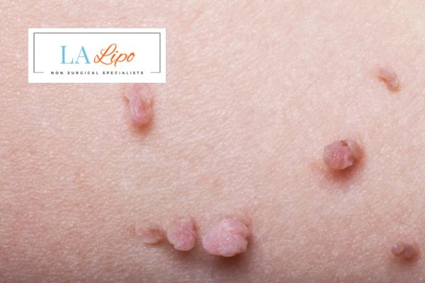 Does cryopen skin tag removal Dunstable hurt? Find out now call our team today!