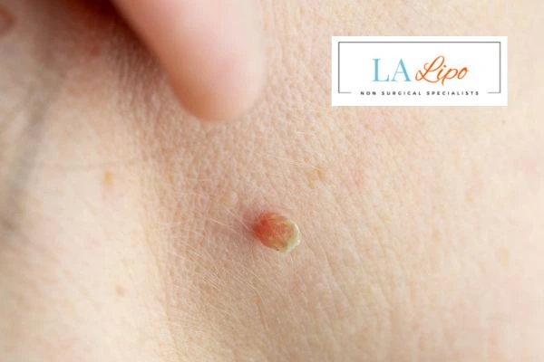 Book skin tag removal Dunstable today speak to our team now!