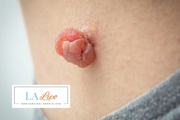 Interested in skin tag removal Dunstable? Concerned about the pain? Find out more today!