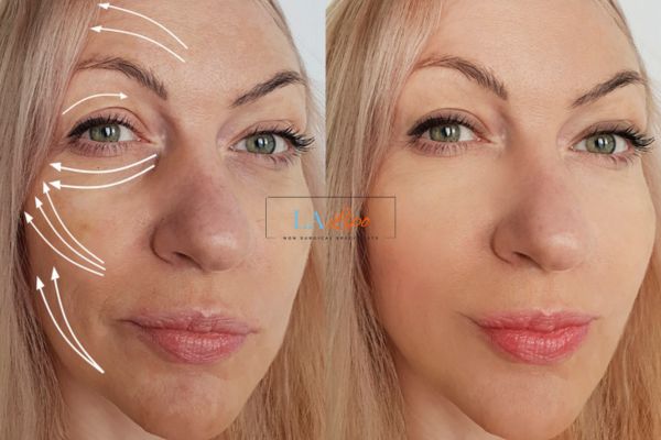 Morpheus 8 results Dunstable face lift.