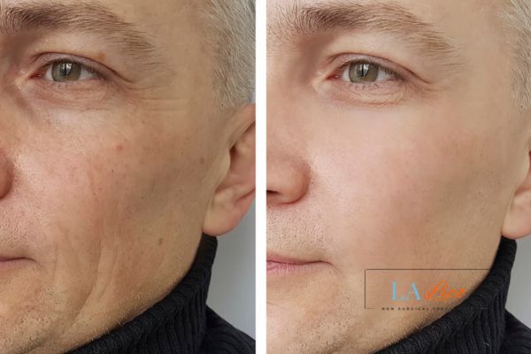 See the amazing results of Morpheus8 Treatment Dunstable!