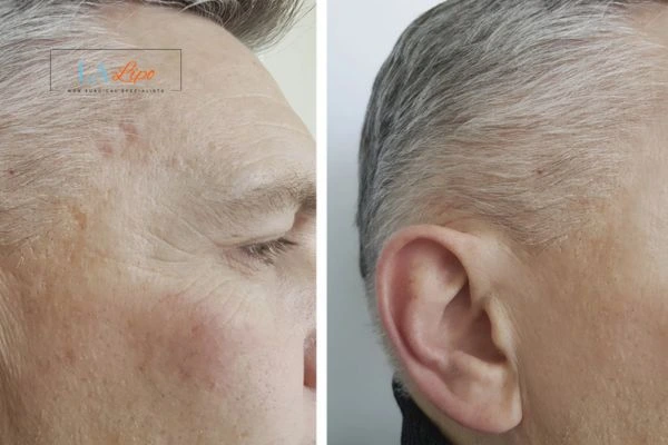 Mens Before & After Morpheus 8 Results Dunstable
