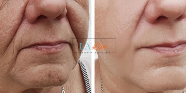 Older lady deeper wrinkle reduction - LA LIPO Morpheus 8 Results Dunstable