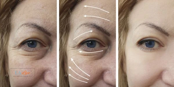 Amazing eye lift Morpheus 8 results Dunstable