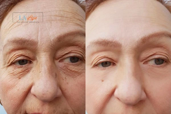 The powerful benefits of Morpheus8 Treatment Dunstable - Call Our team today!