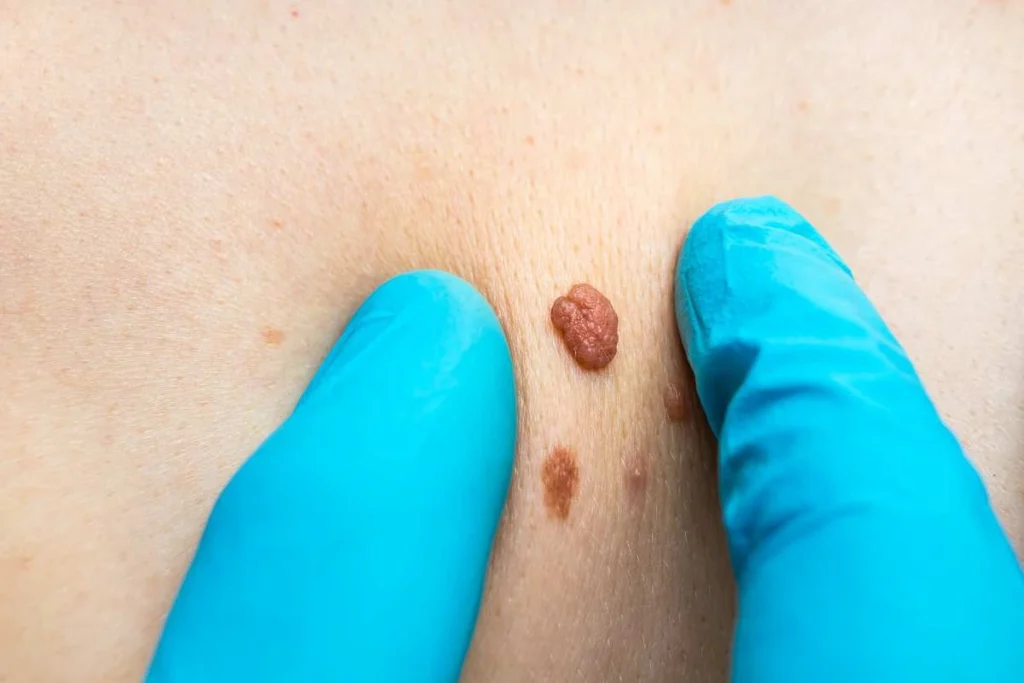 LA LIPO Cryopen Lesion Removal Prices Dunstable
