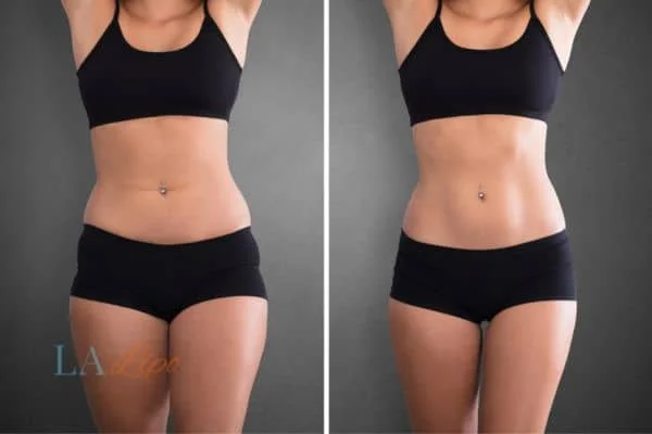 before and after results of non-surgical treatment to help a woman's body image and mental health Dunstable