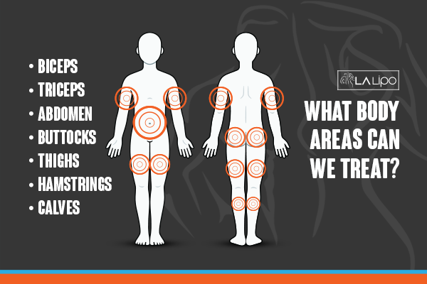 Diagram to show areas you can have LA-EMS Body Sculpting Treatment Dunstable