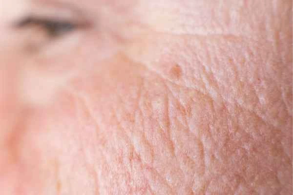 close up picture of a woman's face showing an age spot Dunstable