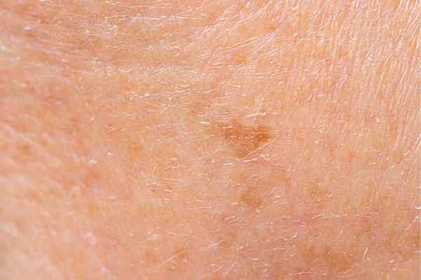 close up picture of age spots Dunstable