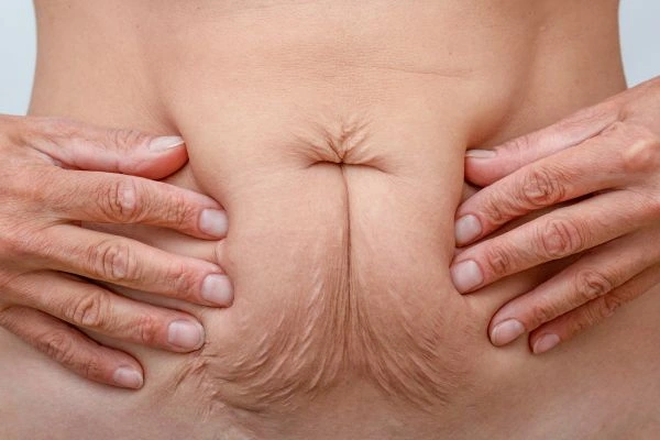 Image of a woman's stomach with loose skin - example of skin tightening Dunstable options