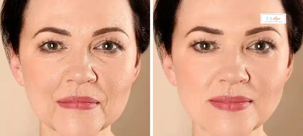 How Long Does It Take to See Results and How Long Do They Last Dunstable?