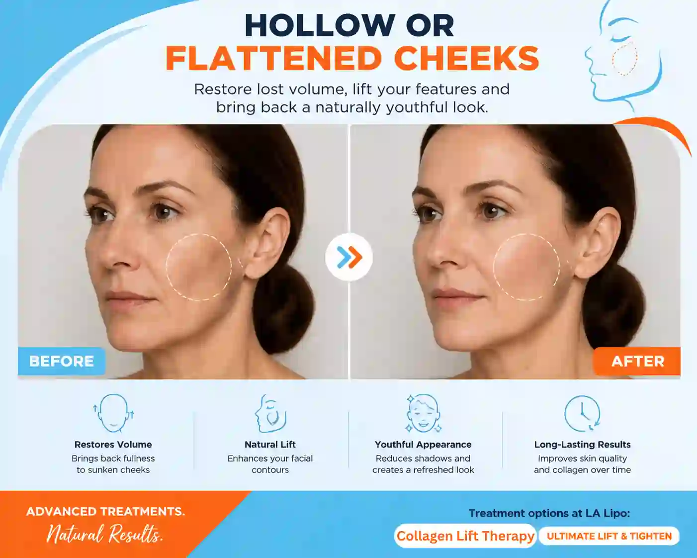 Sign #4: Hollow or Flattened Cheeks Dunstable